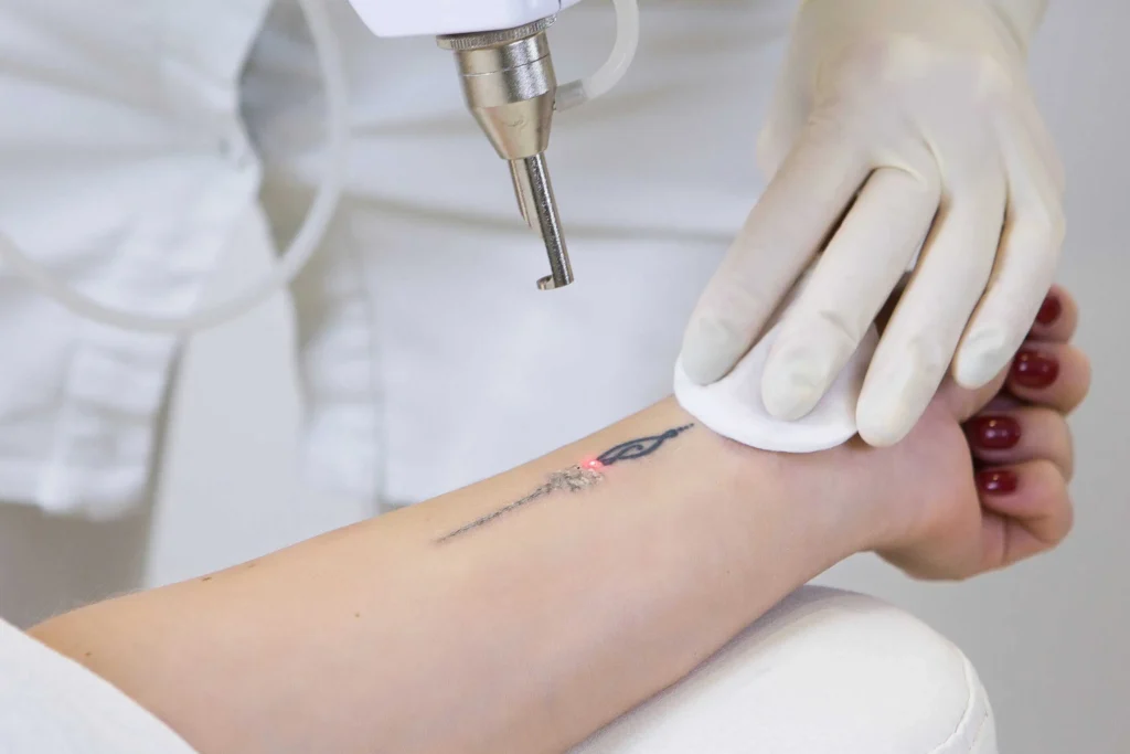 Tattoo Removal by The Natural Place MedSpa S Corp in Broomfield,