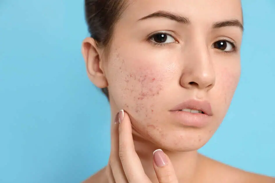 Acne Blue Light in Broomfield, CO by The Natural Place MedSpa S Corp