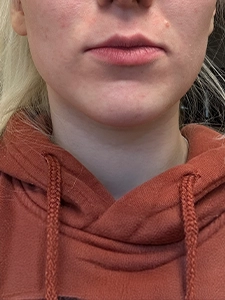 Belotero Lip Filler_After