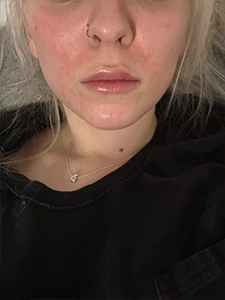 Belotero Lip Filler_Before