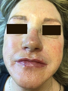Laser Resurfacing 1