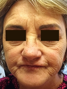 Laser Resurfacing 2