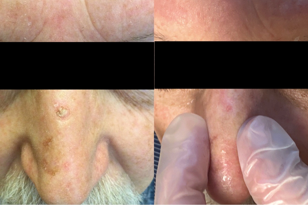 Cryo Before & After 2