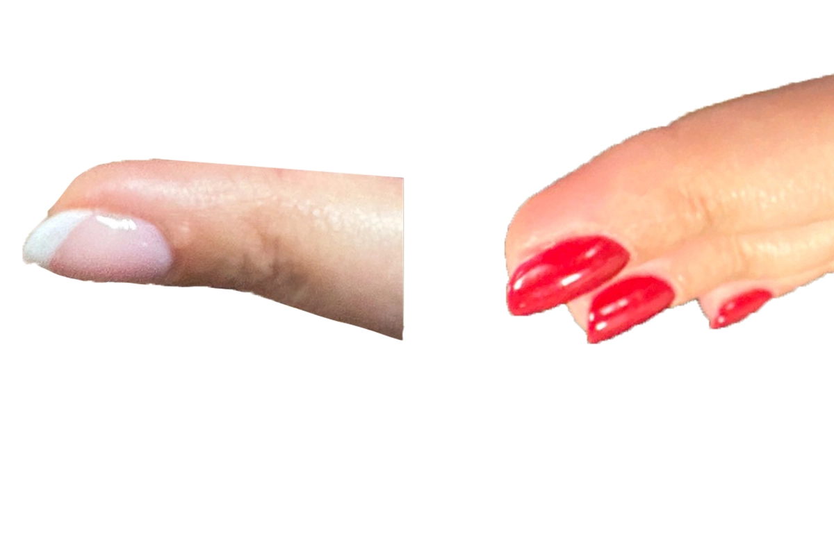Cryo Before & After