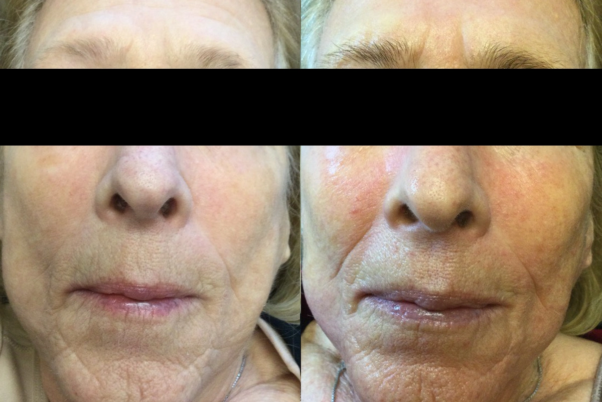 Microderm_1