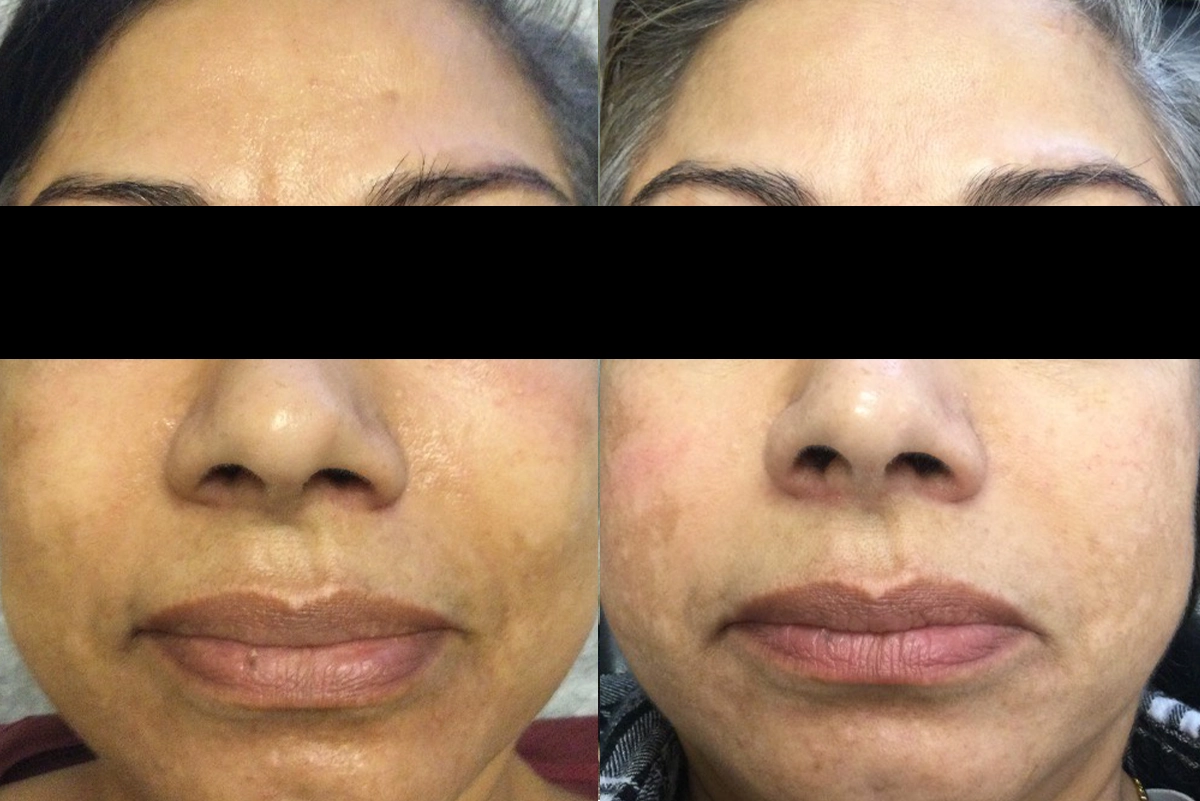 Microderm_2