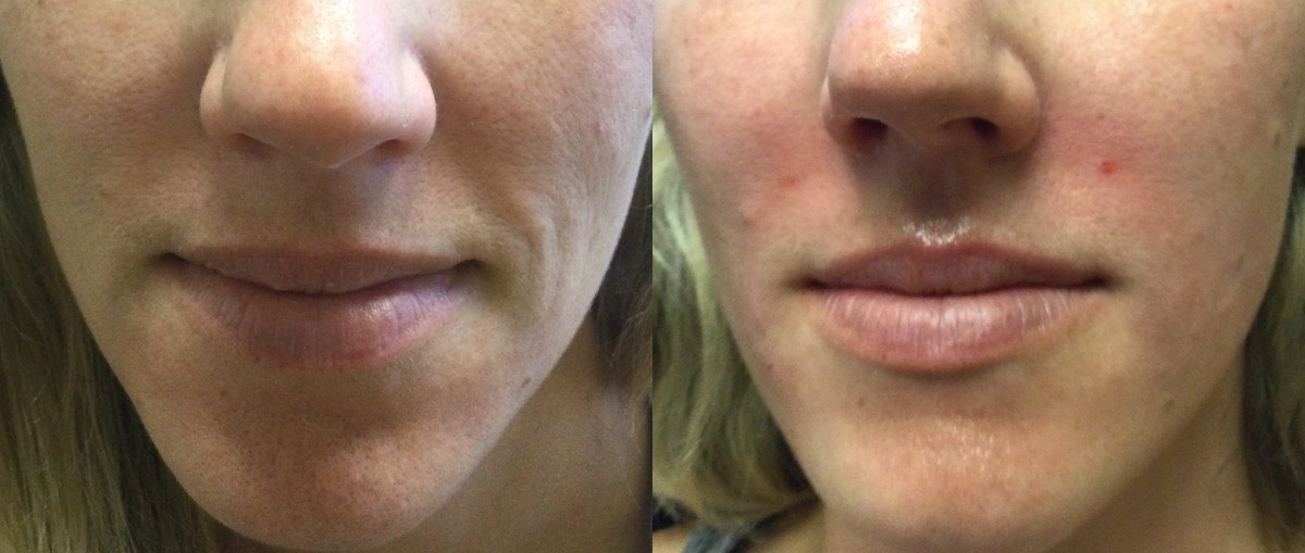 Radiesse Before & after (2)