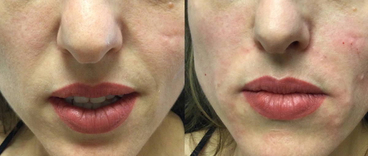 Radiesse before and after pt 2