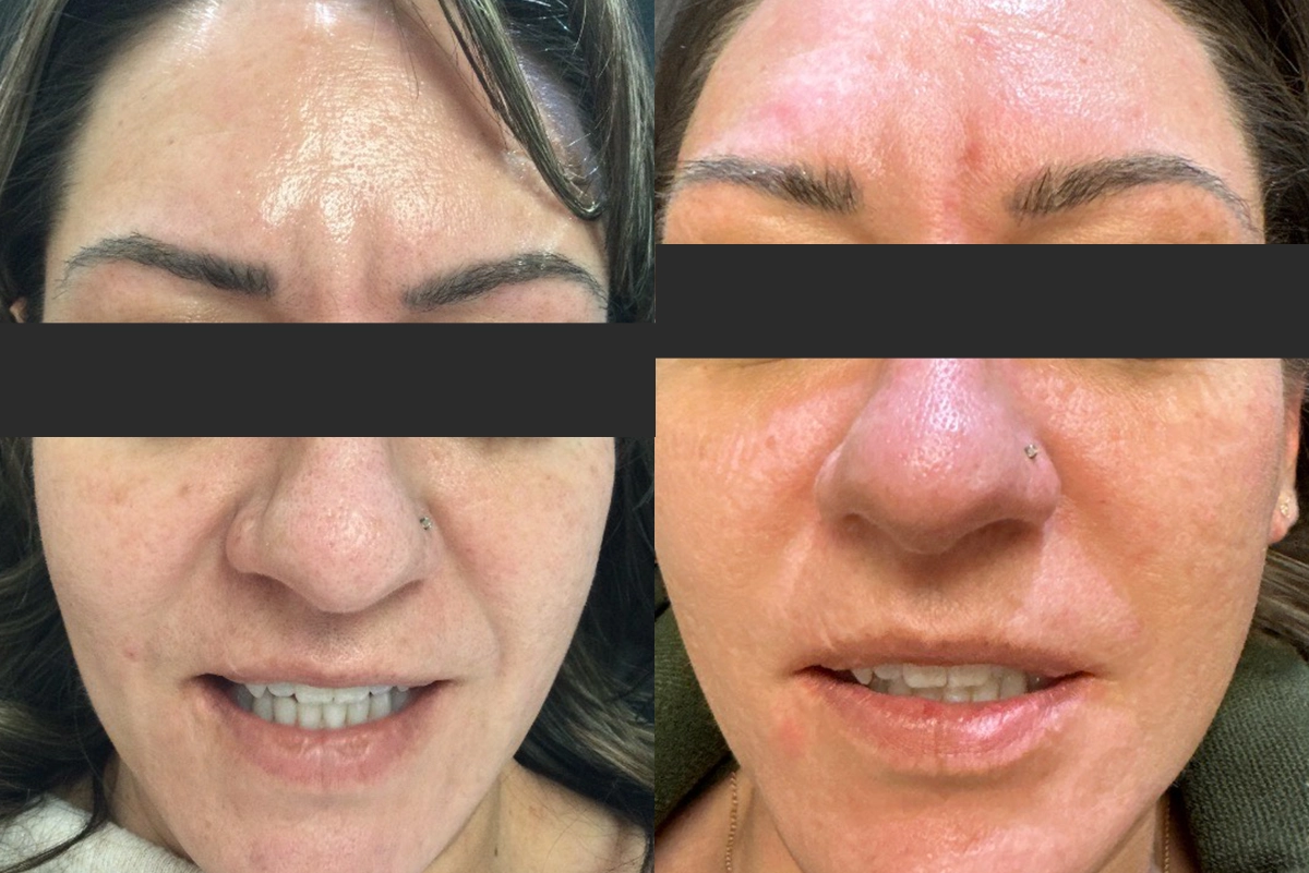 Ultralight Before & After-