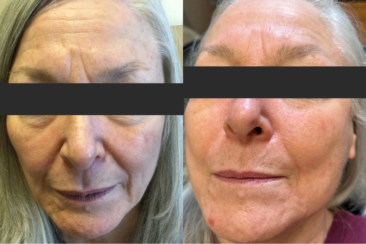 Ultralight Before & After-1