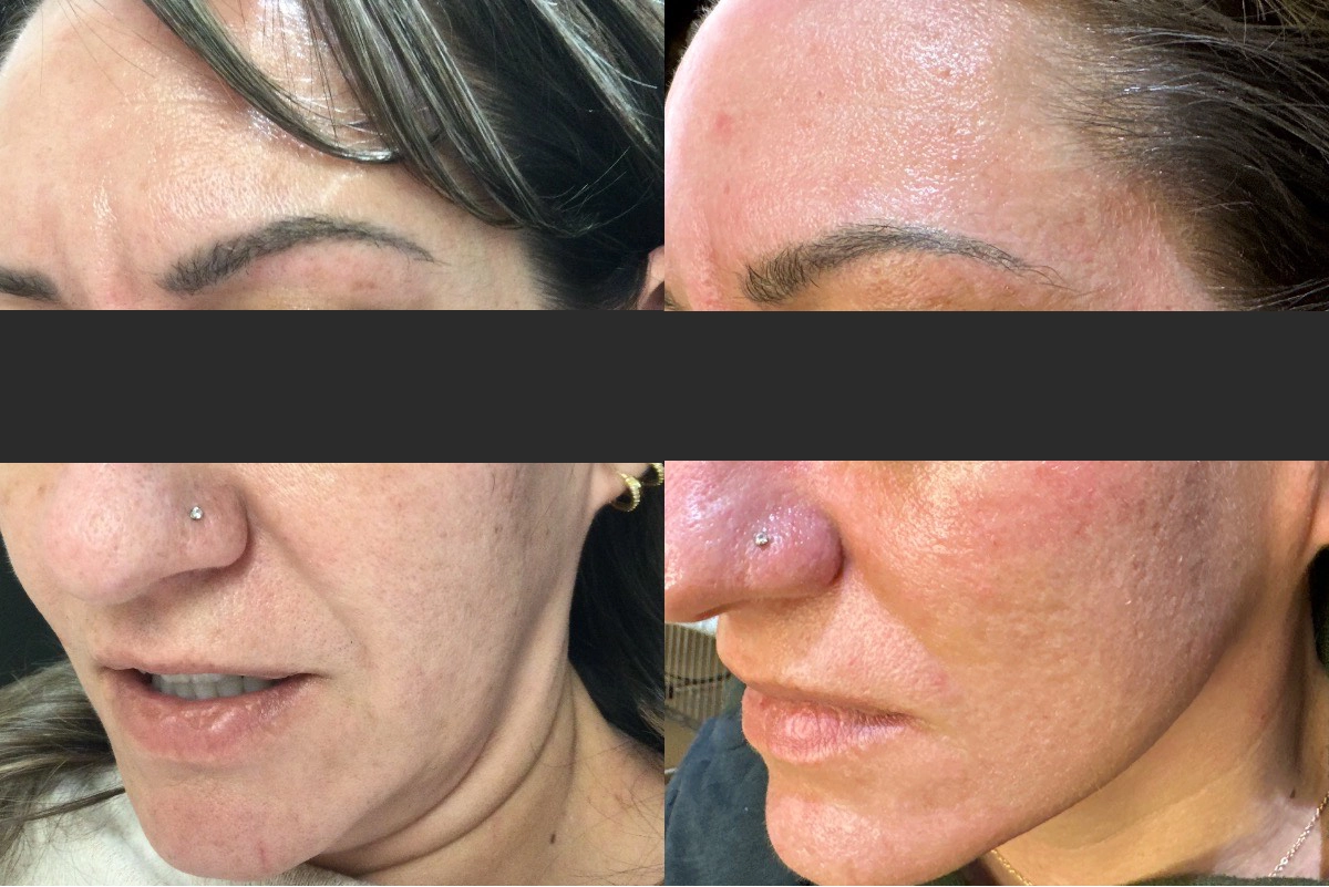 Ultralight Before & After