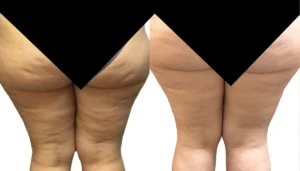 Viora Body Before & After_a