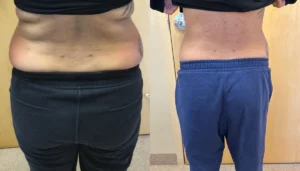 Viora Body Before & After_b