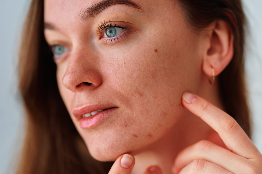 Acne Blue Light Therapy Treatment in Broomfield, CO